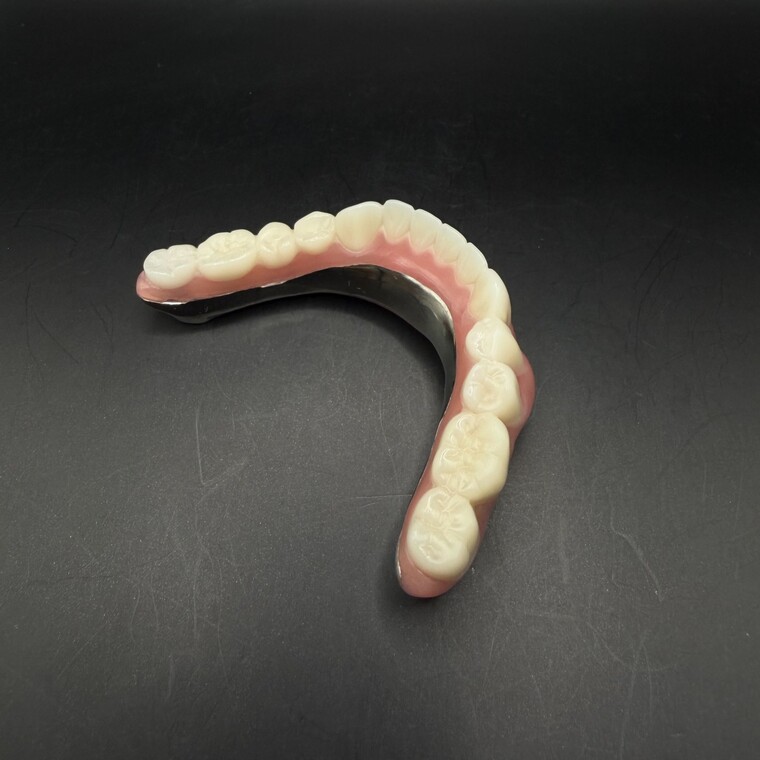 Milled Titanium Implant Dentures