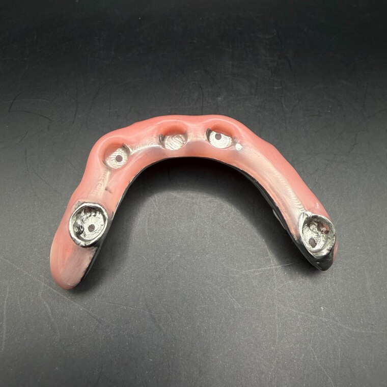 Milled Titanium Implant Dentures